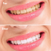 BrightSmile™ | Gjør tennene dine hvitere umiddelbart